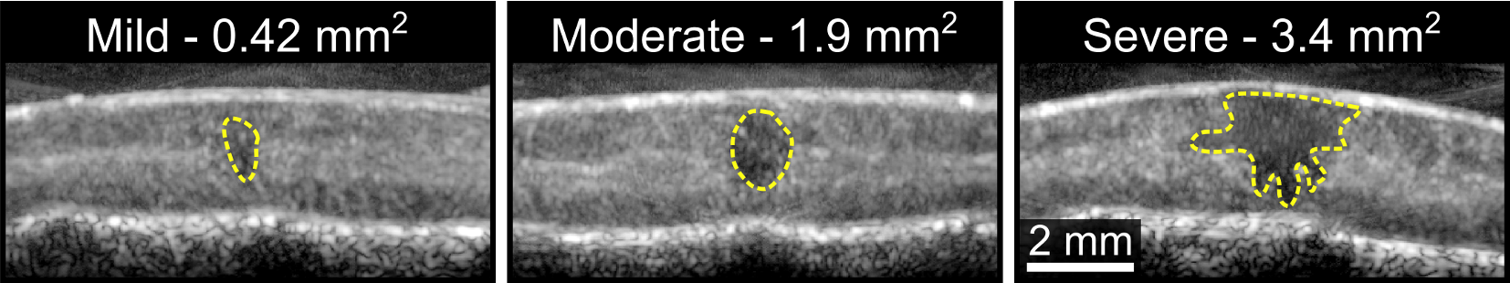 Development of ultrasound-based imaging biomarkers for acute spinal cord injury patients